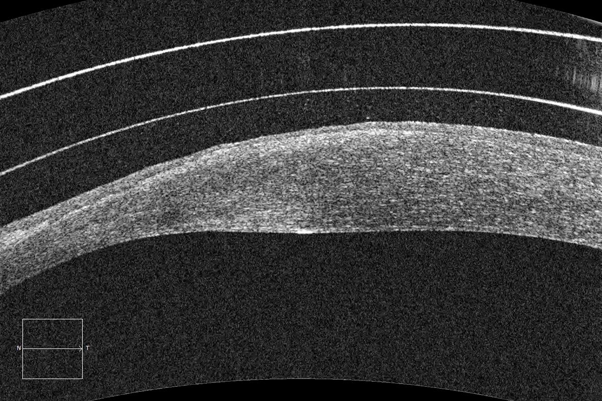Anterior segment OCT scan showing the cornea and a contact lens