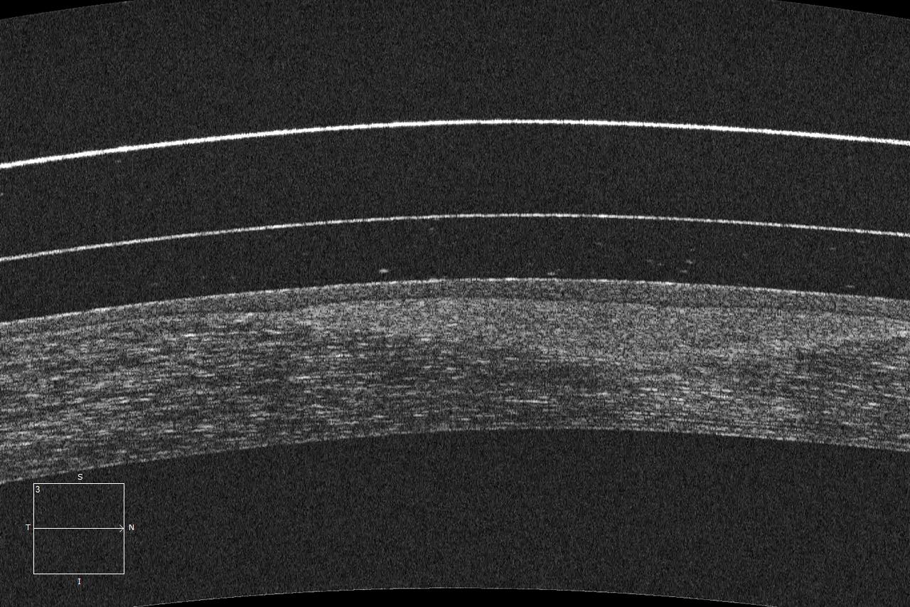 OCT scan used for automated segmentation